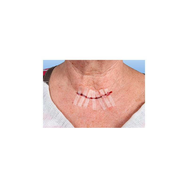 Mehrere RUDASTRIP® Wundnahtstreifen auf einer genähten Halswunde, demonstrieren sicheren Halt und optimale Wundheilung.